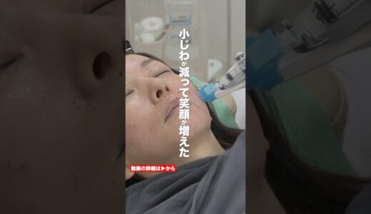 【美容医療】目尻のシワが気になる人は見ないと損します #美容整形 #アンチエイジング #肌の再生医療