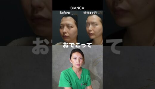 【よくわかる　おでこ整形（脂肪注入/ヒアルロン酸） 症例解説】BIANCA CLINIC