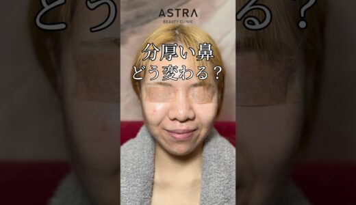 分厚い鼻どう変わる？🤔#astrabeautyclinic  #アストラビューティークリニック #塩満恵子 #鼻整形 #美容整形 #忘れ鼻 #似合わせ鼻 #小鼻縮小#鼻尖形成#耳介軟骨