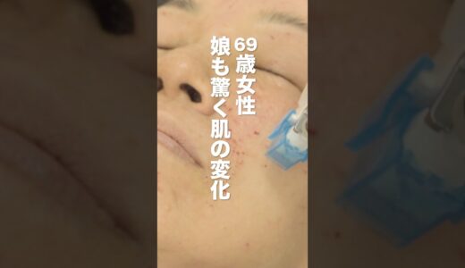 【老化】10歳以上若返ることができる魔法の治療です【美容医療】#しわ #整形 #肌の再生医療