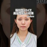 輪郭整えたくて美容整形した結果 #美容 #整形