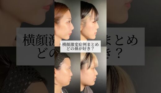 【鼻整形】どの鼻が好き？#shorts