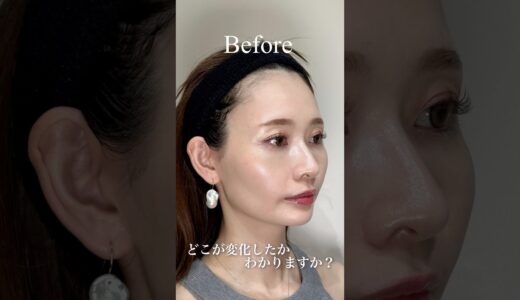 【ビフォーアフター】ヒアルロン酸でどこが変わった？ #美容 #美容整形 #美容皮膚科 #beauty #ヒアルロン酸