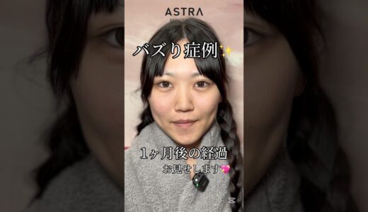 キレイすぎる変化😳✨#astrabeautyclinic  #アストラビューティークリニック #塩満恵子 #鼻整形 #美容整形 #忘れ鼻