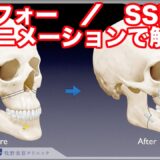 上下顎骨切り術、両顎手術、ルフォー、SSRO（下顎分割矢状骨切り術）についてわかりやすくアニメーションで紹介