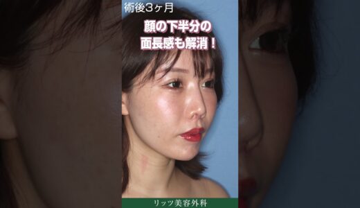 30代女性の美容整形、鼻の修正手術と人中短縮術とオトガイ骨切り術で美人顔に！