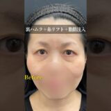 【50代のクマ取り】　#控えめな形成外科専門医#美容外科専門医#整形#クマ取り #裏ハムラ #ダウンタイム#クマ治療  #クマ取りダウンタイム#脱脂 #脂肪注入 #糸リフト　#形成外科専門医