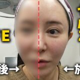 【美容整形】ウルセラではない？Ziって何？ひとまず当ててみた