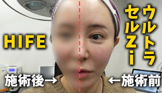 【美容整形】ウルセラではない？Ziって何？ひとまず当ててみた