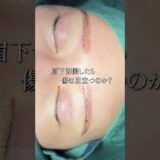 眉下切開したら傷は目立つのか？#美容整形 #眉下切開 #整形メイク